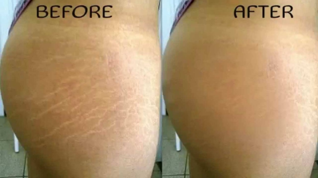 Pictures - Scars and stretch marks before and after