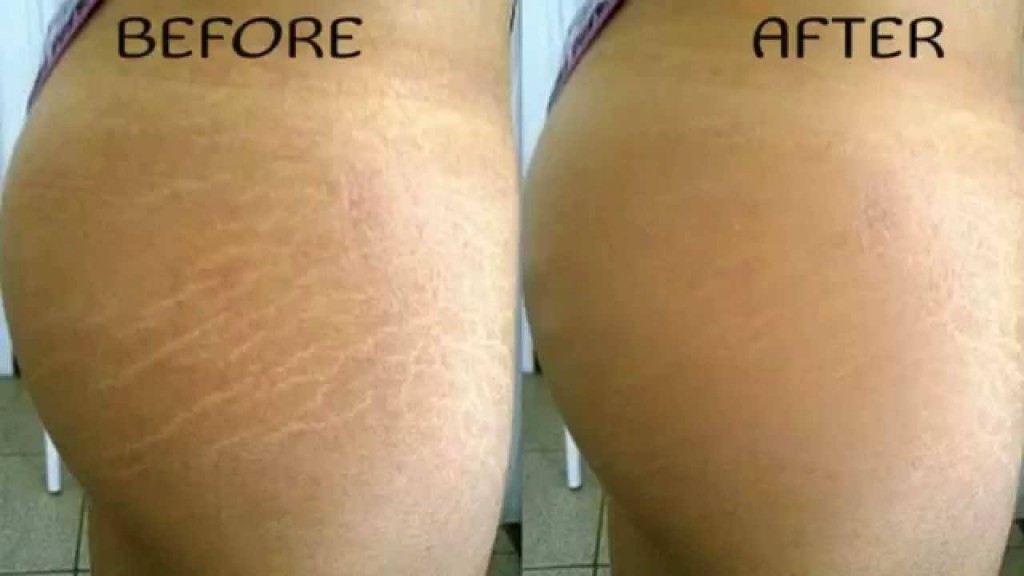 How to Get Rid of Stretch Marks: 14 Steps (with Pictures)