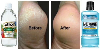 How to Fix Cracked Feet Fast