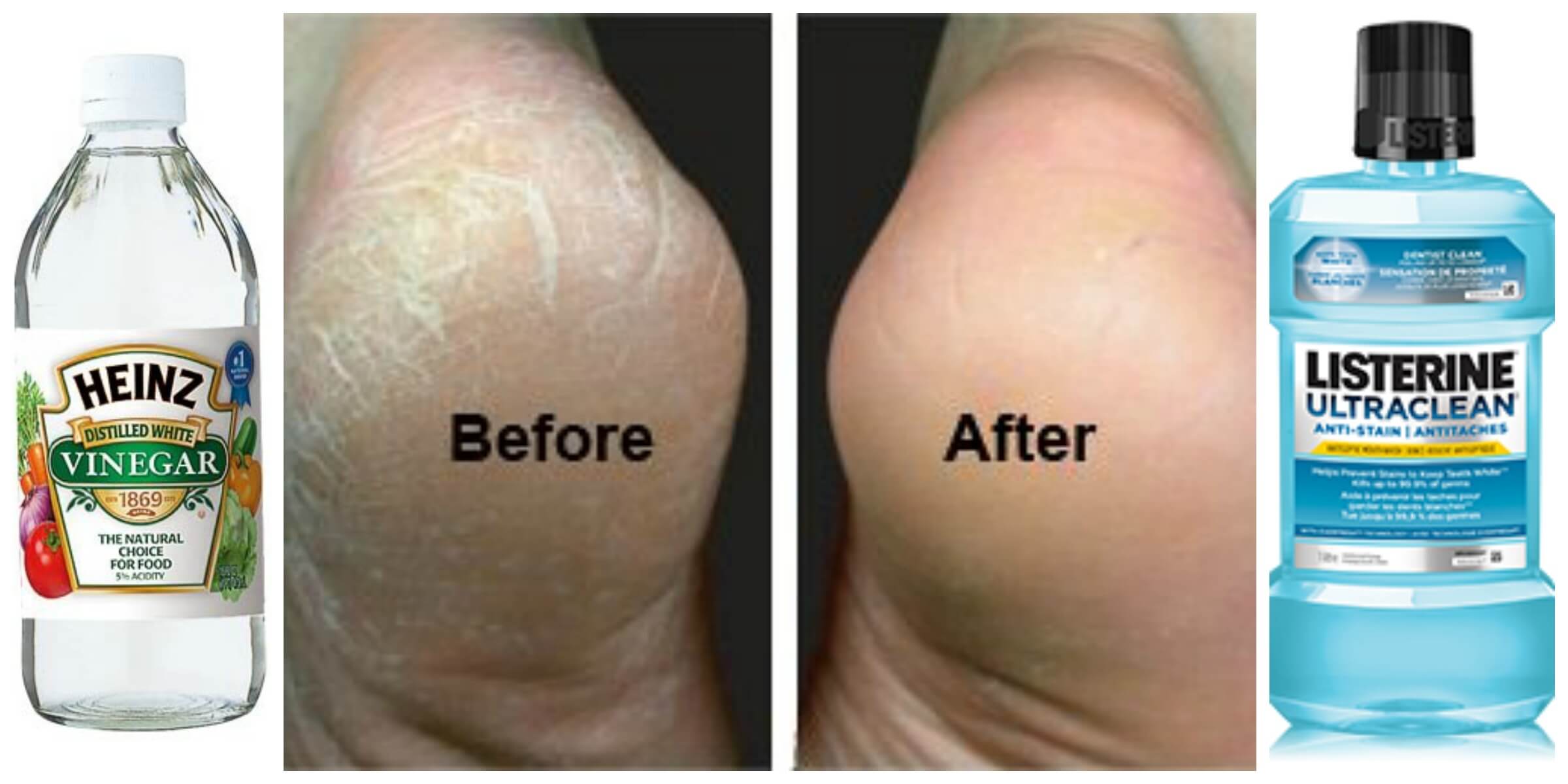 How To Heal Dry Cracked Feet Fast