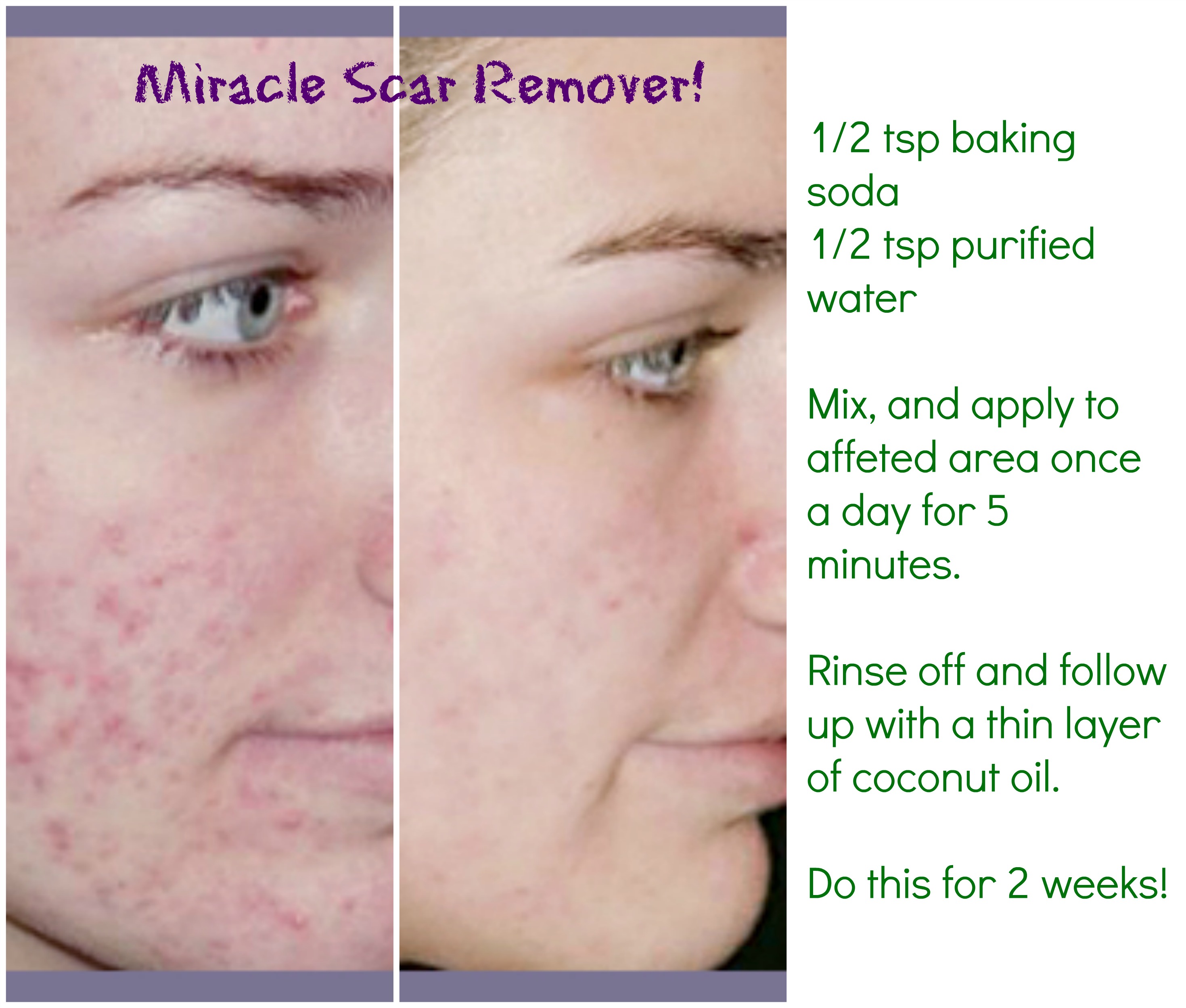 DIY Natural Scar Remover - Works WONDERS And It's Cheap!