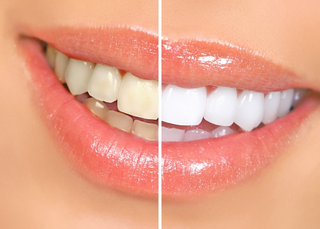 tricks to whiter looking teeth