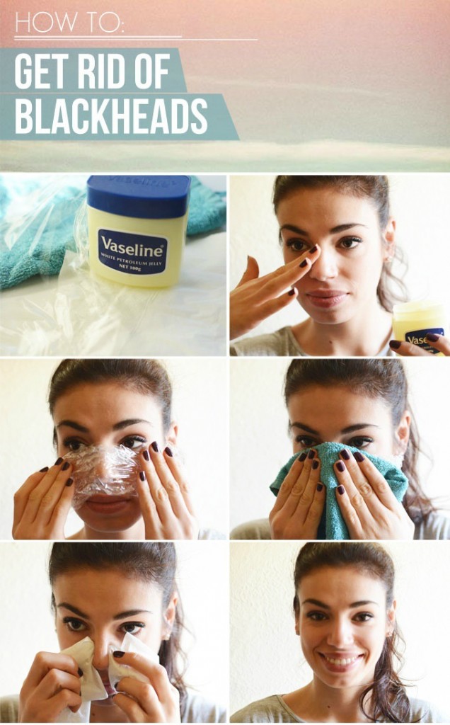 get rid of blackheads