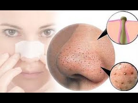 how to get rid of blackheads2