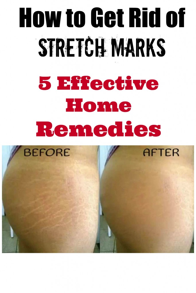 get rid of stretch marks