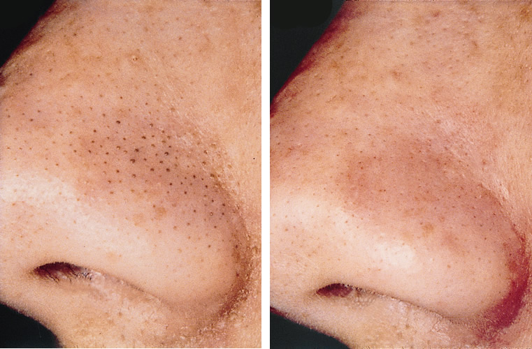 blackheads before and after