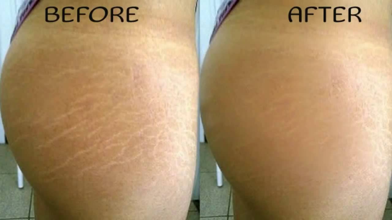 How To Get Rid Of Stretch Marks On Back From Growing