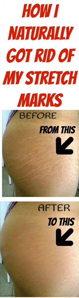 how to get rid of stretch marks