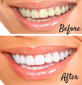 before-and-after-teeth-whitening