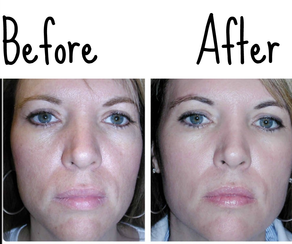 Vaseline Wrinkles Before And After