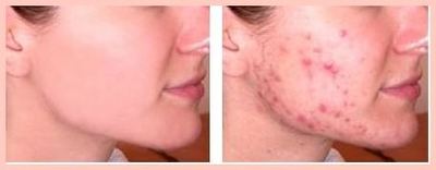 cystic acne before and after