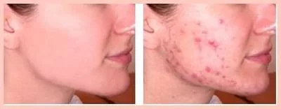 Ondergedompeld veteraan Plenaire sessie How I Cured My Cystic Acne In 30 Days
