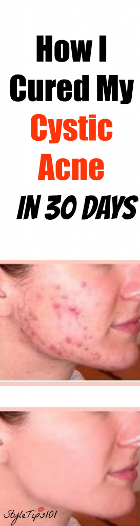 cystic acne