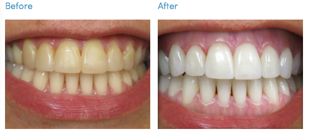 before and after teeth whitening