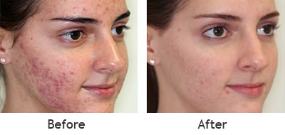 Witch Hazel Acne Before And After