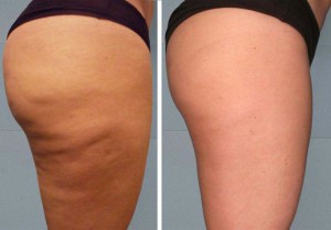 before and after cellulite