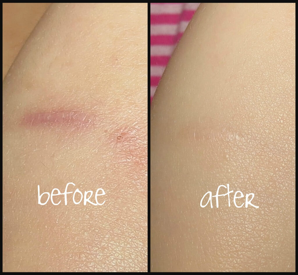 before and after scar on leg