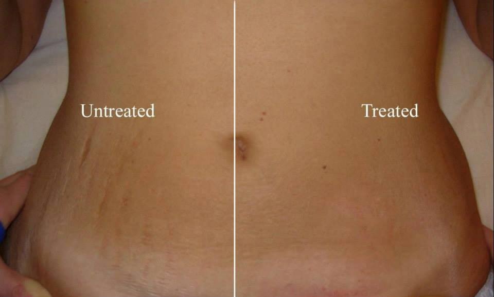 stretch mark treatment