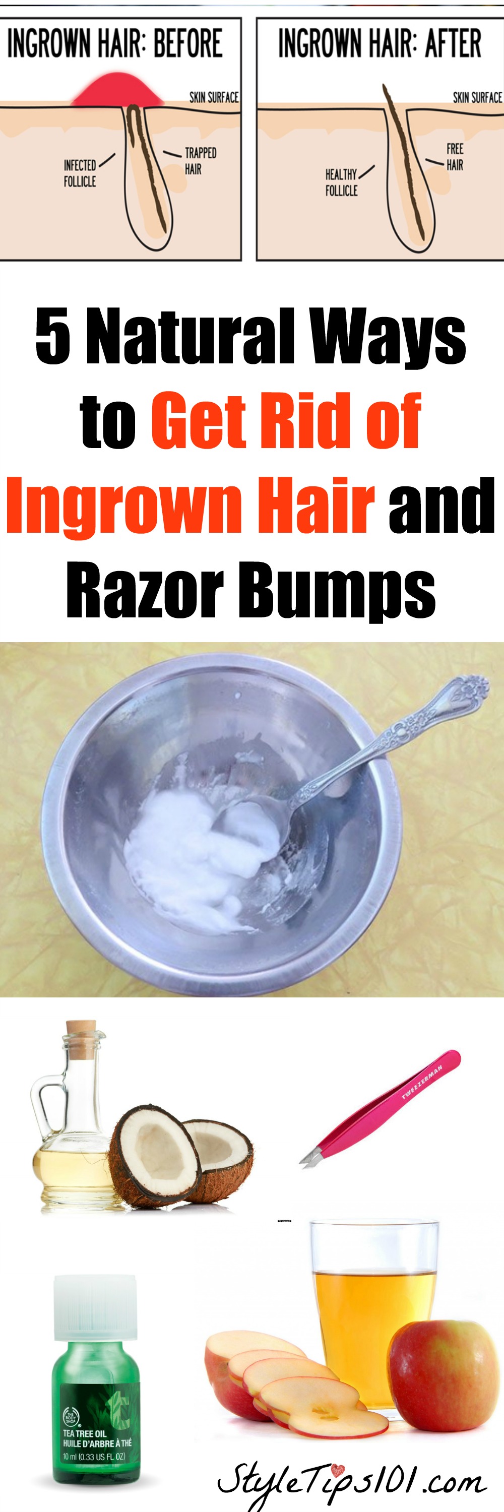 how to get an ingrown hair out