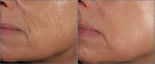aging skin before and after
