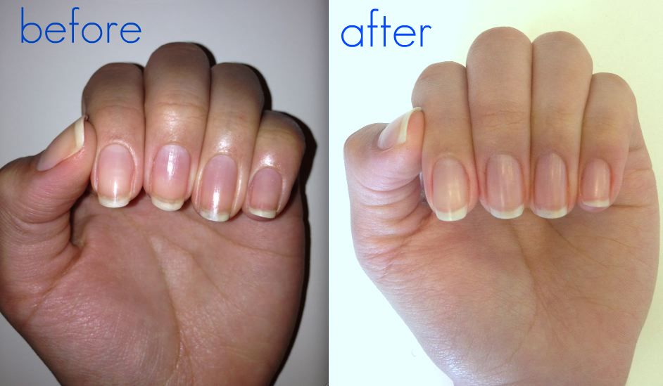 before and after yellow nails
