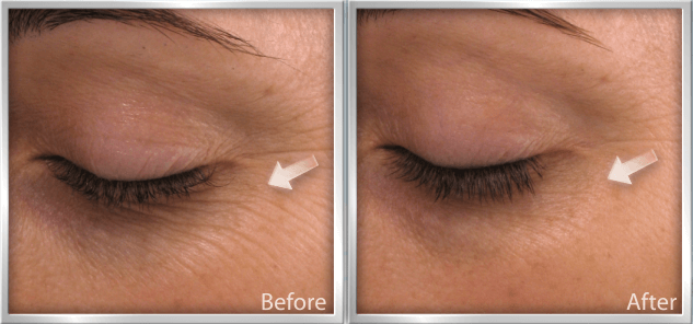 How To Get Rid Of Fine Lines Before And After They Appear