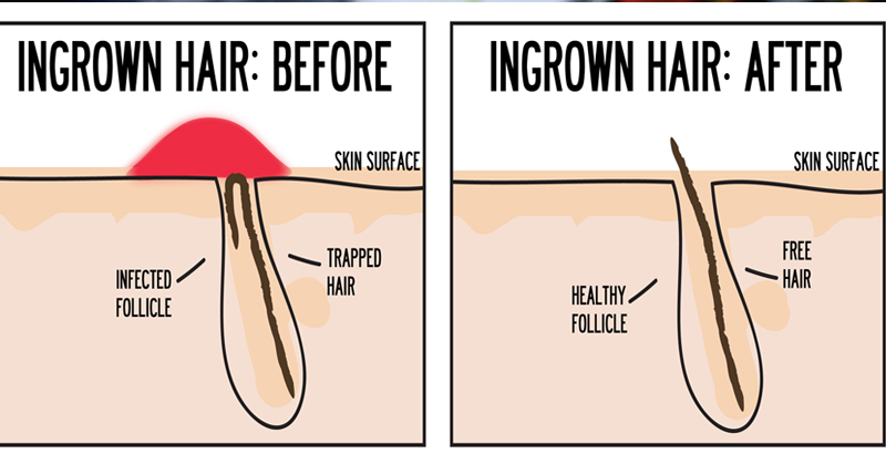 Ingrown Hair Simple And Effective Home Remedies For Ingrown Hair