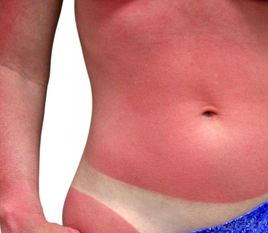 home remedies for sunburn