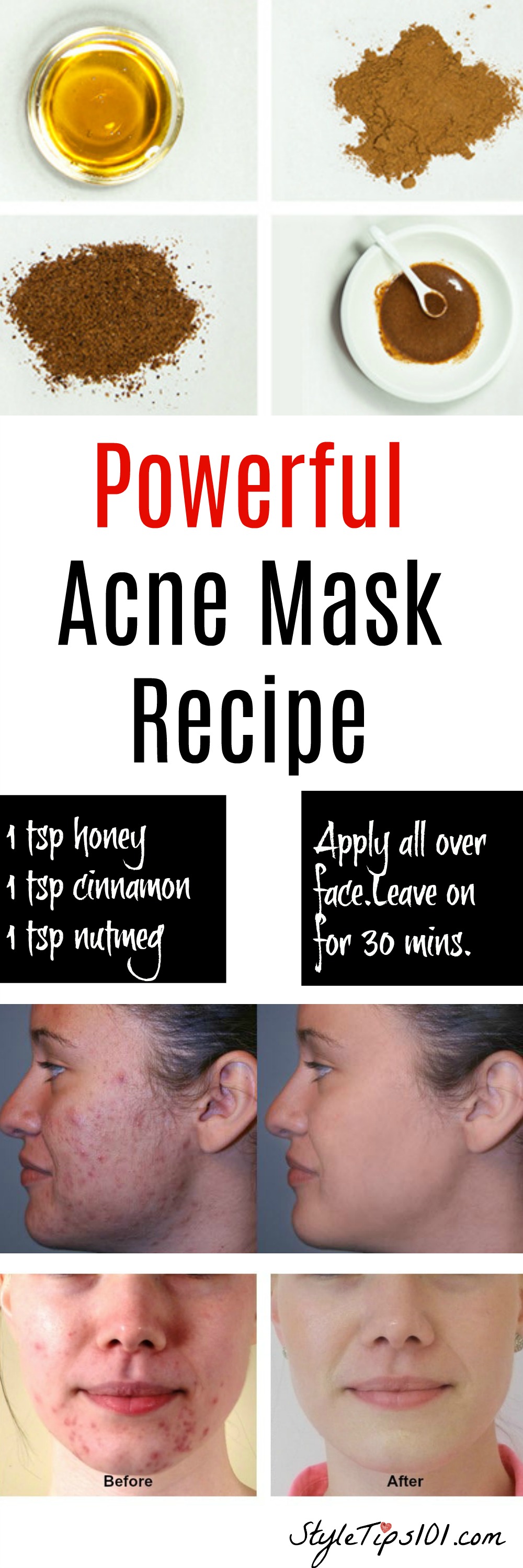 Homemade Natural Acne Mask