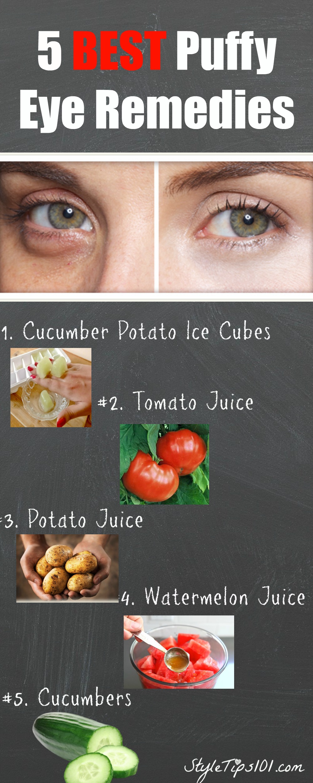 Puff Eye Remedies