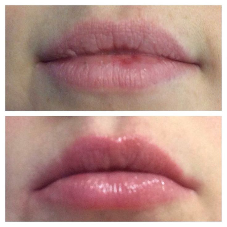 before and after chapped lips