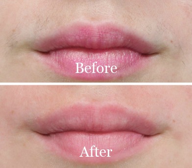 before and after upper lip hair removal