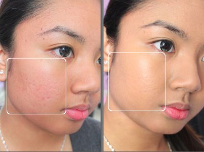 before and after uneven skin tone