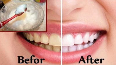 baking soda and lemon for teeth whitening