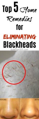 home remedies for blackheads