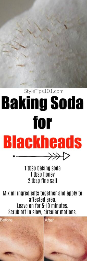 Baking Soda for Blackheads