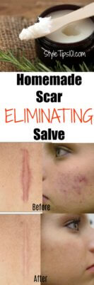 Homemade Scar Removing Salve