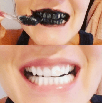 activated charcoal teeth