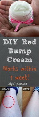 DIY Red Bump Cream