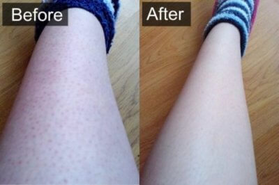 before and after red bumps