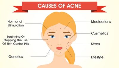 acne causes