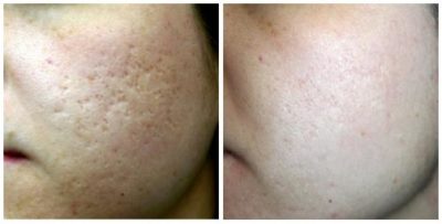 before and after facial acne scars