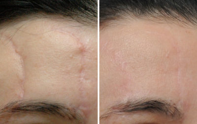 before and after facial scars