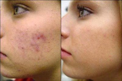 before and after acne scar treatment