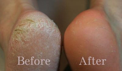 before and after dry feet