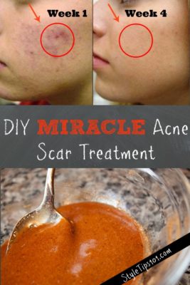 diy acne scar treatment