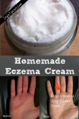 Homemade Eczema Cream