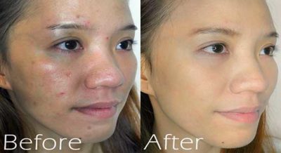 before and after acne face mask