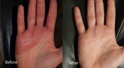 before and after eczema