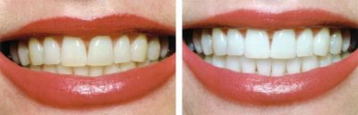 before and after teeth whitening